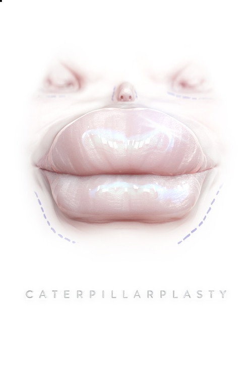 Caterpillarplasty постер